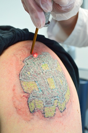 Trinity laser tattoo - Tattoo removal Detroit Plastic Surgery