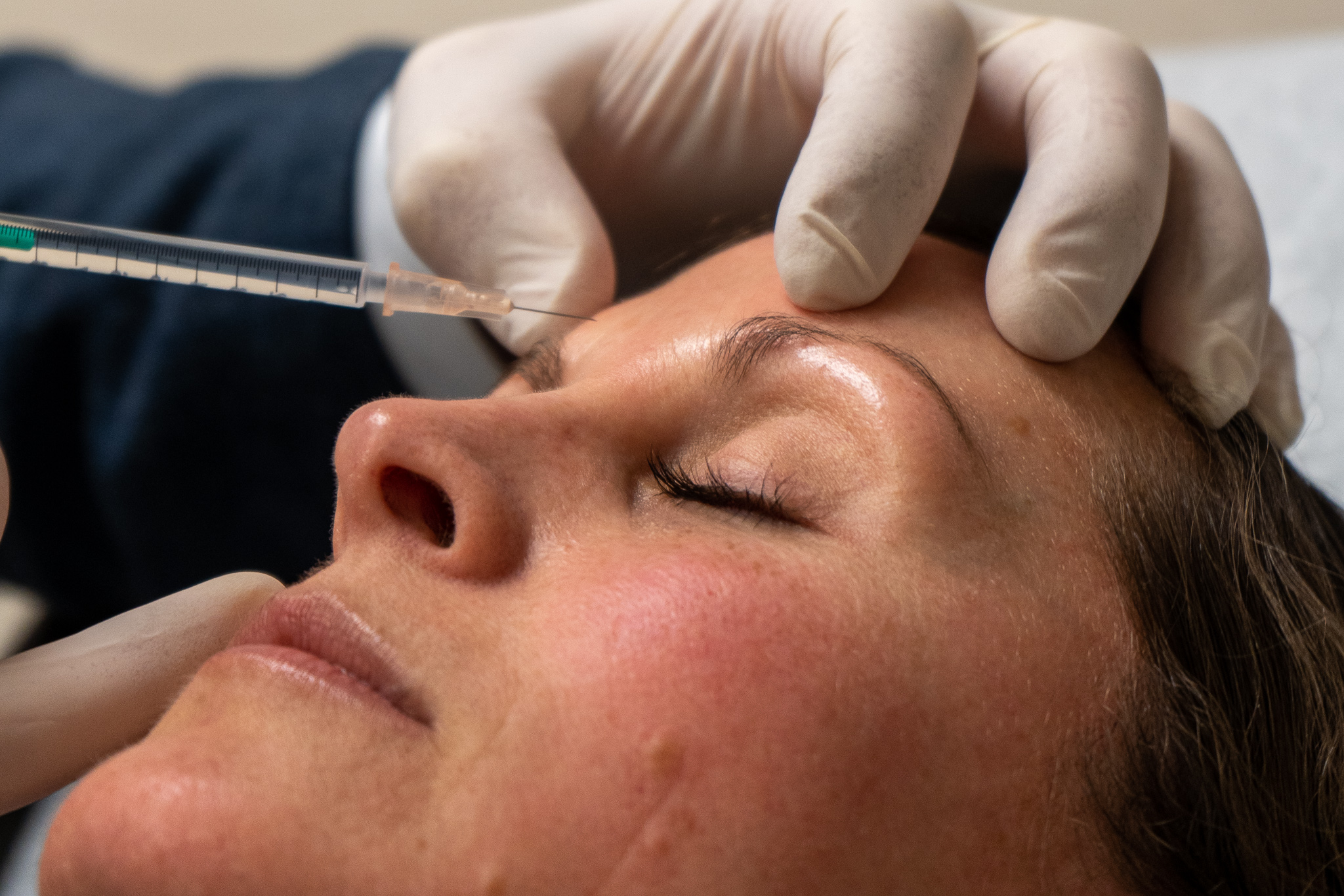 Detroit Plastic Surgery Facial Fillers